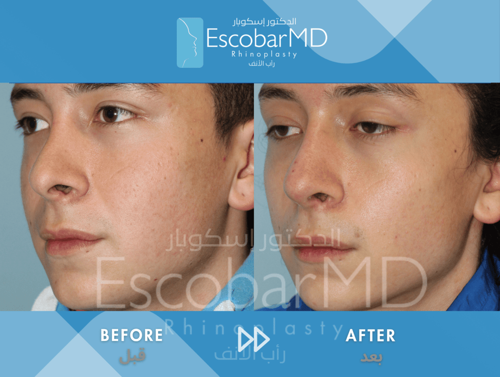 Closed Revision Rhinoplasty in Men Dubai 4 Close Revision Rhinoplasty Dr Escobar UAE (3)