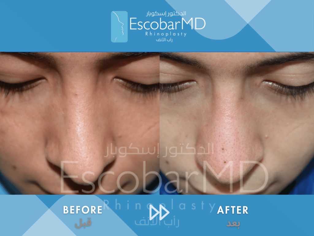 Closed Revision Rhinoplasty in Men Dubai 6 Close Revision Rhinoplasty Dr Escobar UAE (6)