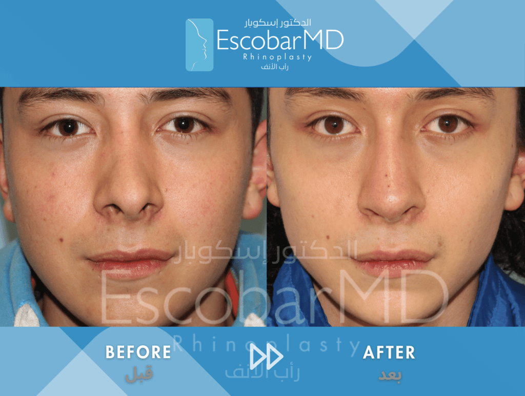 Closed Revision Rhinoplasty in Men Dubai 1 Close Revision Rhinoplasty Dr Escobar UAE (7)