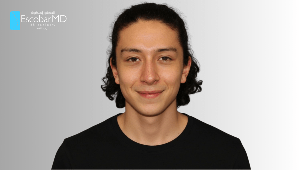 Closed Revision Rhinoplasty in Men Dubai 7 REVISION RHINOPLASTY— Where Expertise Restores Confidence (2)